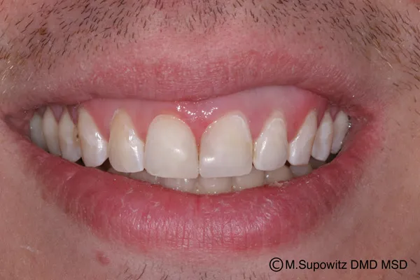 Patient's mouth after dental bonding