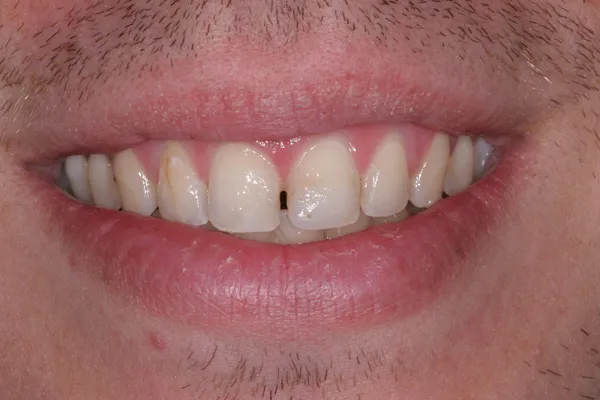 Patient's mouth before dental bonding