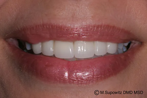 Patient's mouth after dental bridges