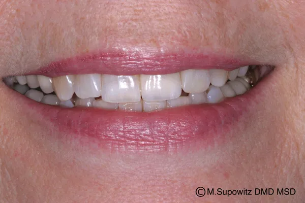 Patient's mouth after dental implants