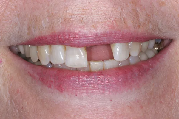 Patient's mouth before dental implants