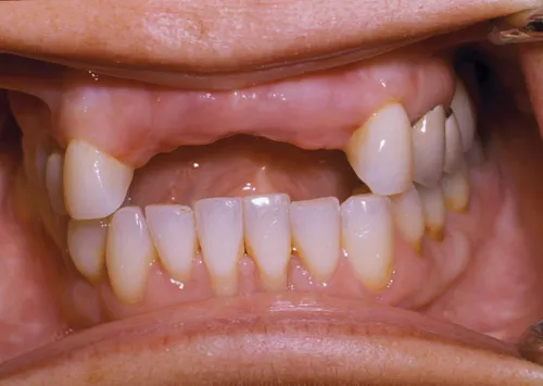 Patient's mouth before dental implants