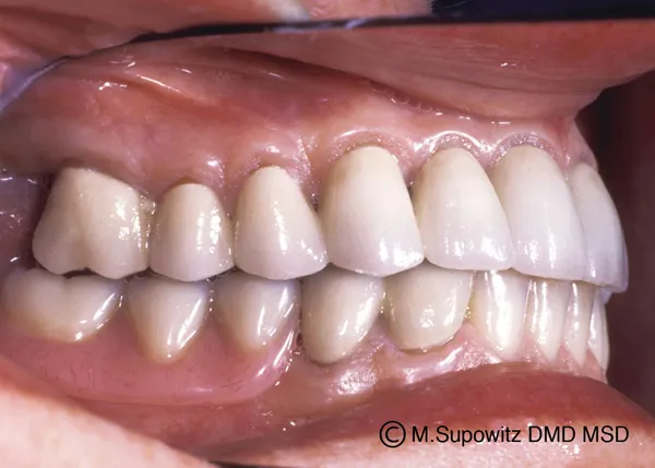 Patient's mouth after dental partials