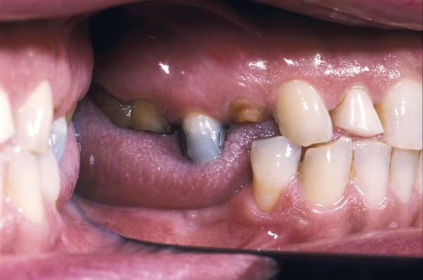 Patient's mouth before dental partials