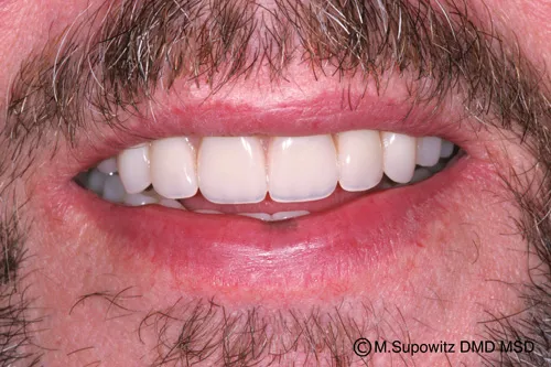 Patient's mouth after dentures