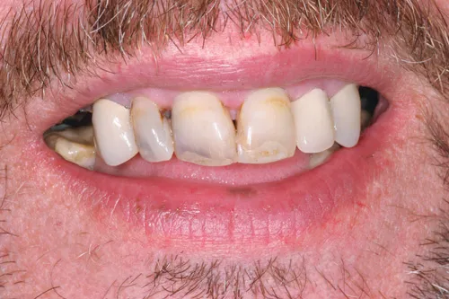 Patient's mouth before dentures