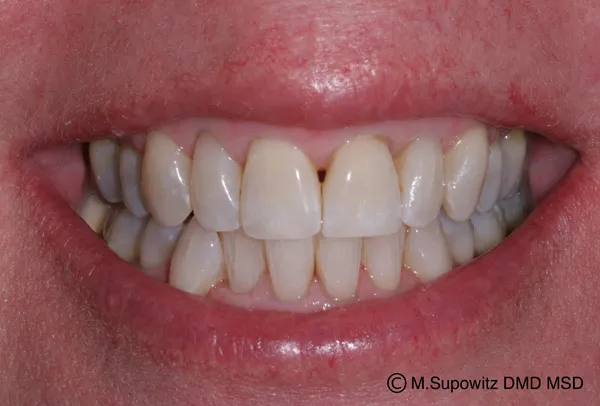 Patient's mouth after esthetic reshaping