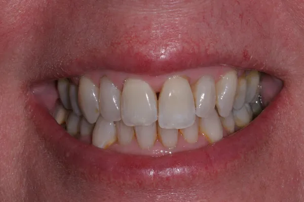Patient's mouth before esthetic reshaping
