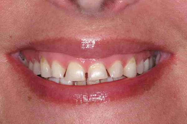Patient's mouth before a smile makeover