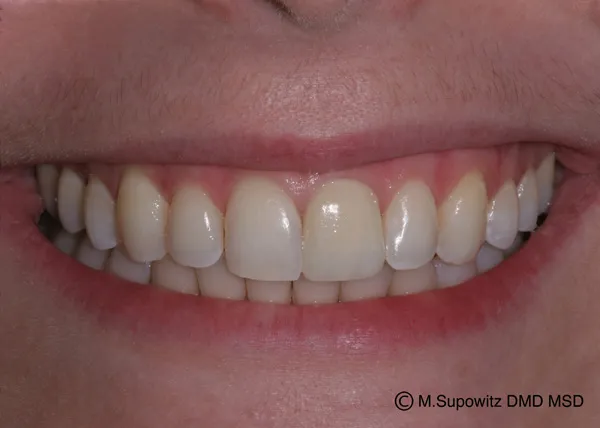Patient's mouth after teeth whitening