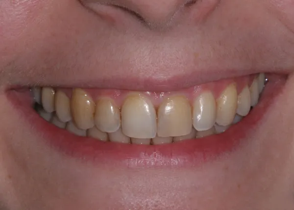 Patient's mouth before teeth whitening