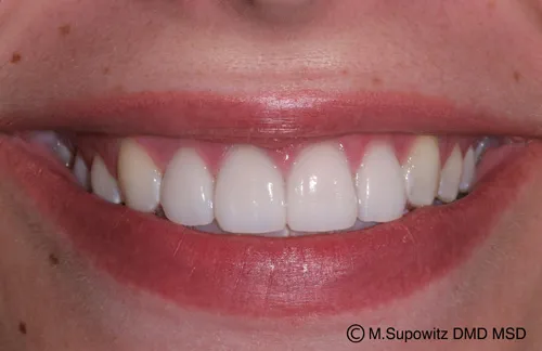 Patient's mouth after porcelain veneers