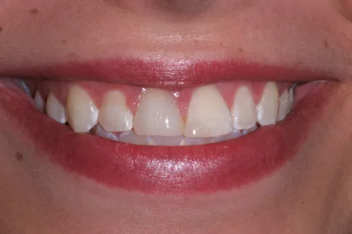 Patient's mouth before porcelain veneers
