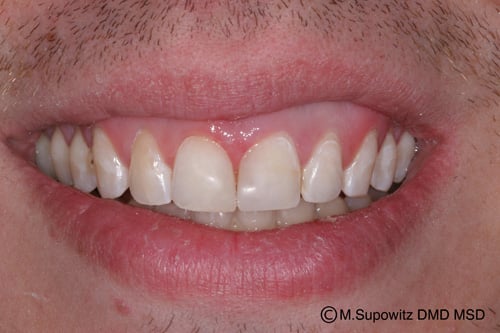 Patient's mouth after tooth bonding