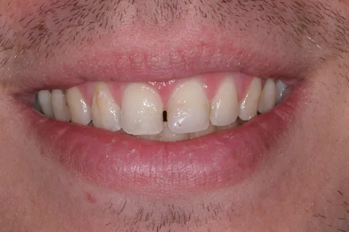 Patient's mouth before tooth bonding