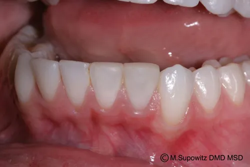 Patient's mouth after tooth bonding