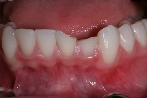 Patient's mouth before tooth bonding