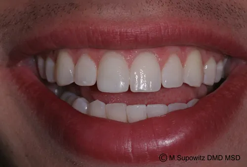 Patient's mouth after tooth bonding