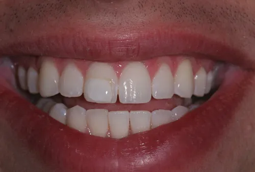 Patient's mouth before tooth bonding