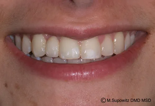 Patient's mouth after tooth bonding
