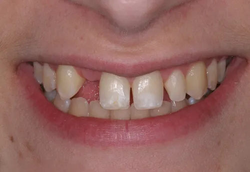 Patient's mouth before tooth bonding