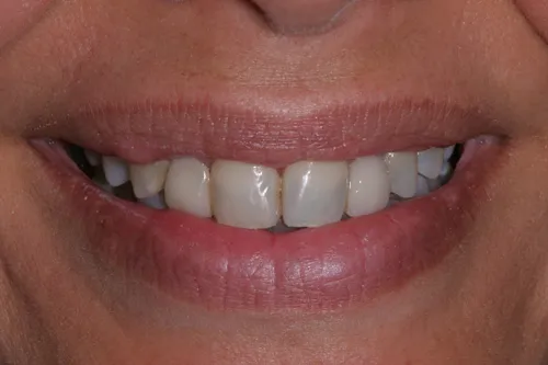 Patient's mouth before dental bridges