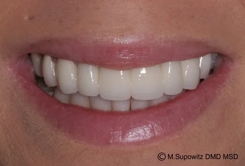 Patient's mouth after dental bridges
