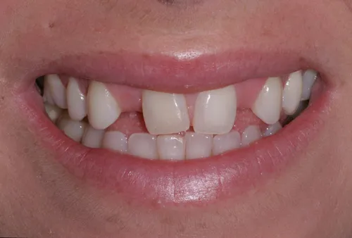Patient's mouth before dental bridges