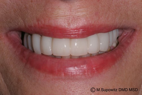 Temporary Crown &amp; Bridge Photo Gallery | Pittsburgh PA