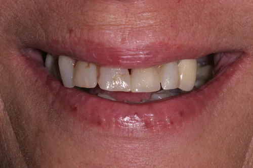 Patient's mouth before a temporary crown and bridge