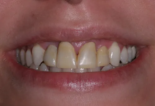 Patient's mouth before a temporary crown and bridge