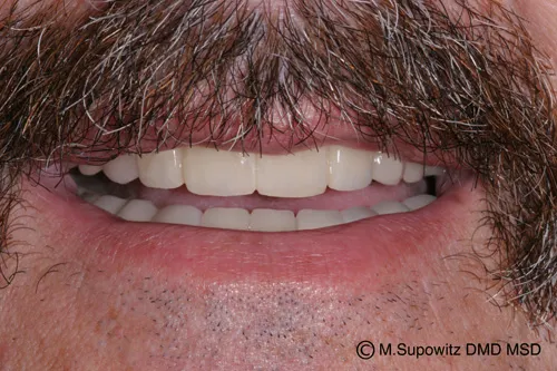 Patient's mouth after a temporary crown and bridge