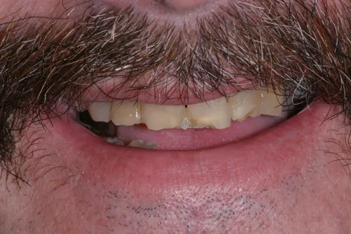 Patient's mouth before a temporary crown and bridge