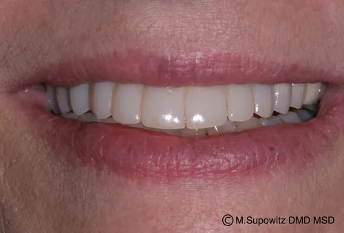 Patient's mouth after a temporary crown and bridge
