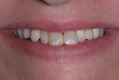 Patient's mouth before a temporary crown and bridge