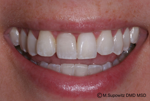 Patient's mouth after dental crowns
