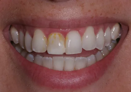 Patient's mouth before dental crowns
