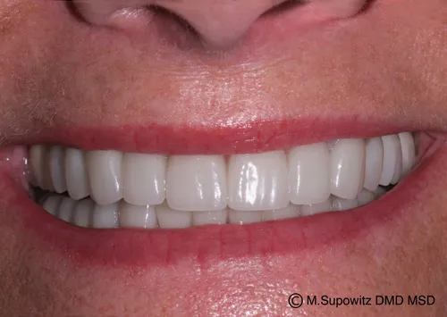 Patient's mouth after dental crowns