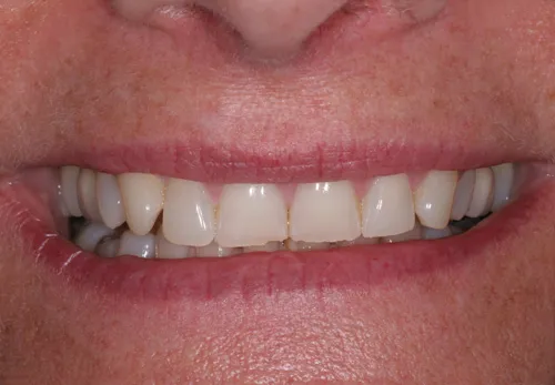 Patient's mouth before dental crowns