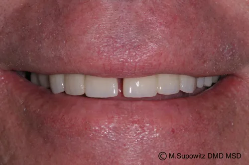 Patient's mouth after dental crowns