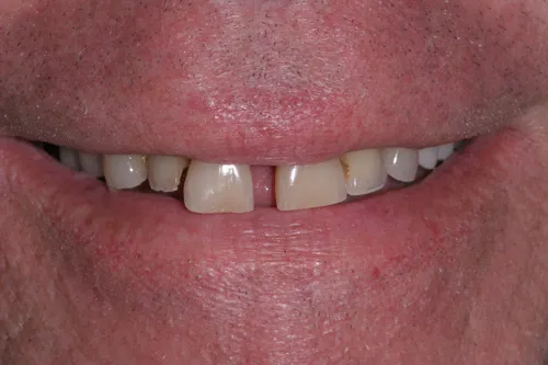 Patient's mouth before dental crowns