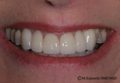 Patient's mouth after dental crowns