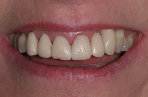 Patient's mouth before dental crowns