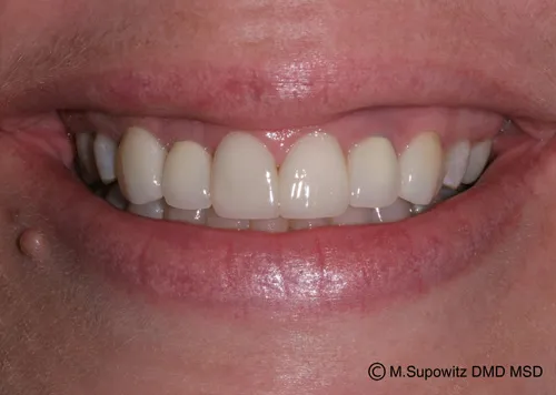 Patient's mouth after dental implants