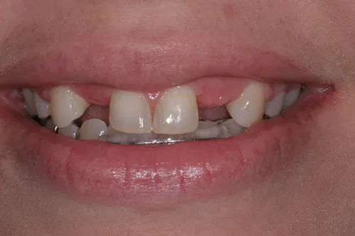 Patient's mouth before dental implants