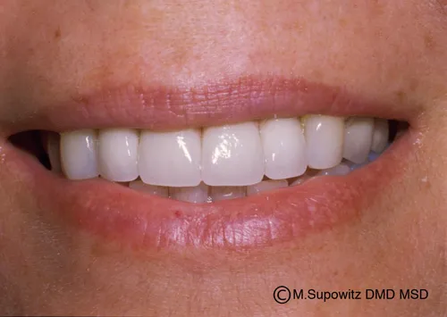 Patient's mouth after dental implants