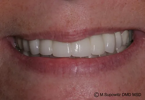 Patient's mouth after dental implants