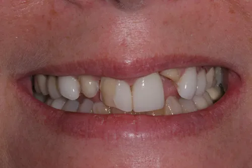 Patient's mouth before dental implants