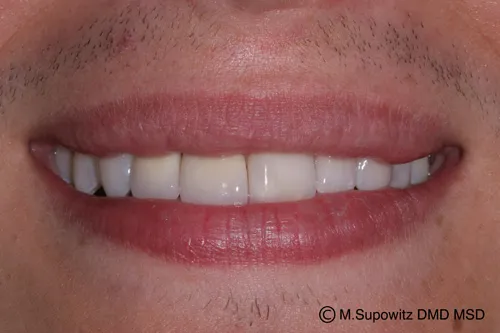 Patient's mouth after dental implants