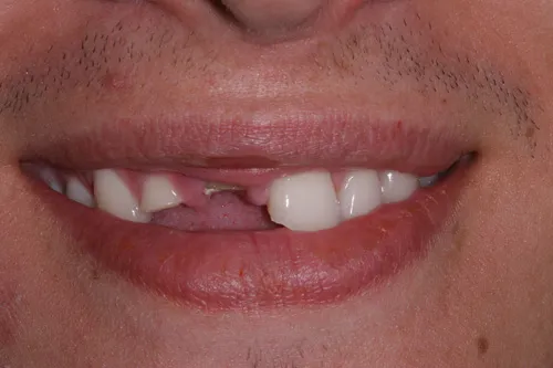 Patient's mouth before dental implants